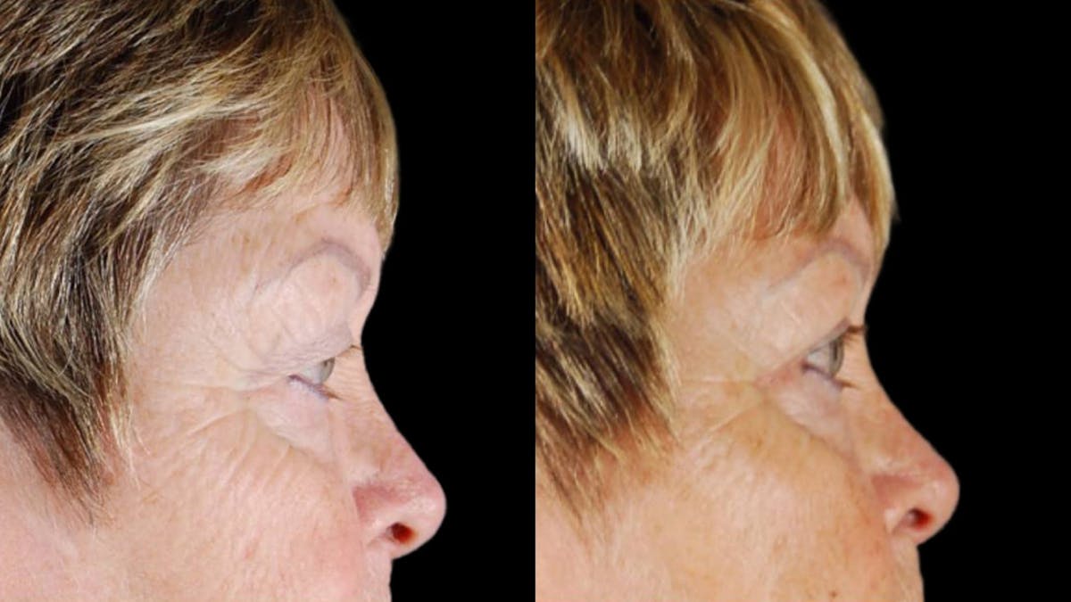 Upper Eyelid Surgery Before & After Gallery - Patient 350657 - Image 4