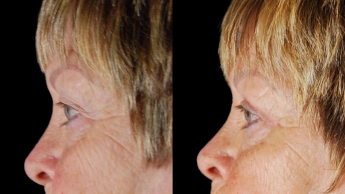 Upper Eyelid Surgery Before & After Gallery - Patient 350657 - Image 3