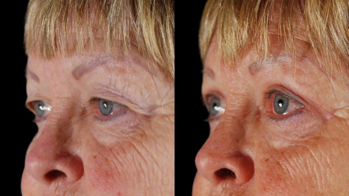 Upper Eyelid Surgery Before & After Gallery - Patient 350657 - Image 1