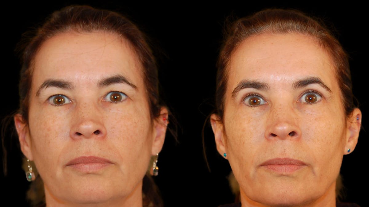 Upper Eyelid Surgery Before & After Gallery - Patient 304034 - Image 2