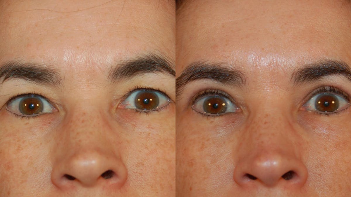 Upper Eyelid Surgery Before & After Gallery - Patient 304034 - Image 3