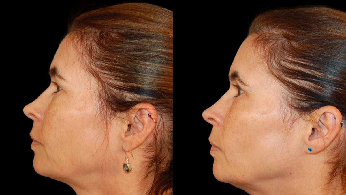 Upper Eyelid Surgery Before & After Gallery - Patient 304034 - Image 9