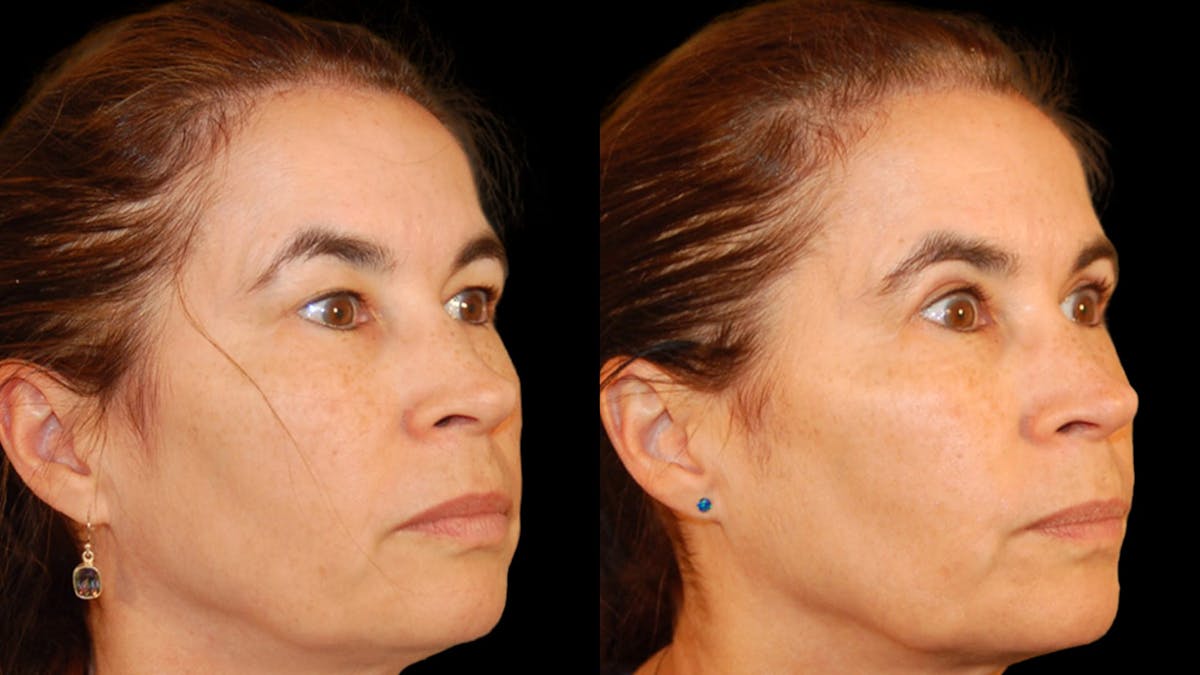 Upper Eyelid Surgery Before & After Gallery - Patient 304034 - Image 6