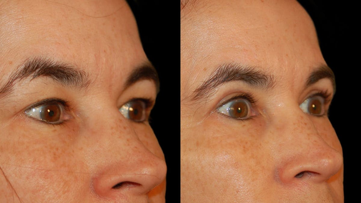 Upper Eyelid Surgery Before & After Gallery - Patient 304034 - Image 5