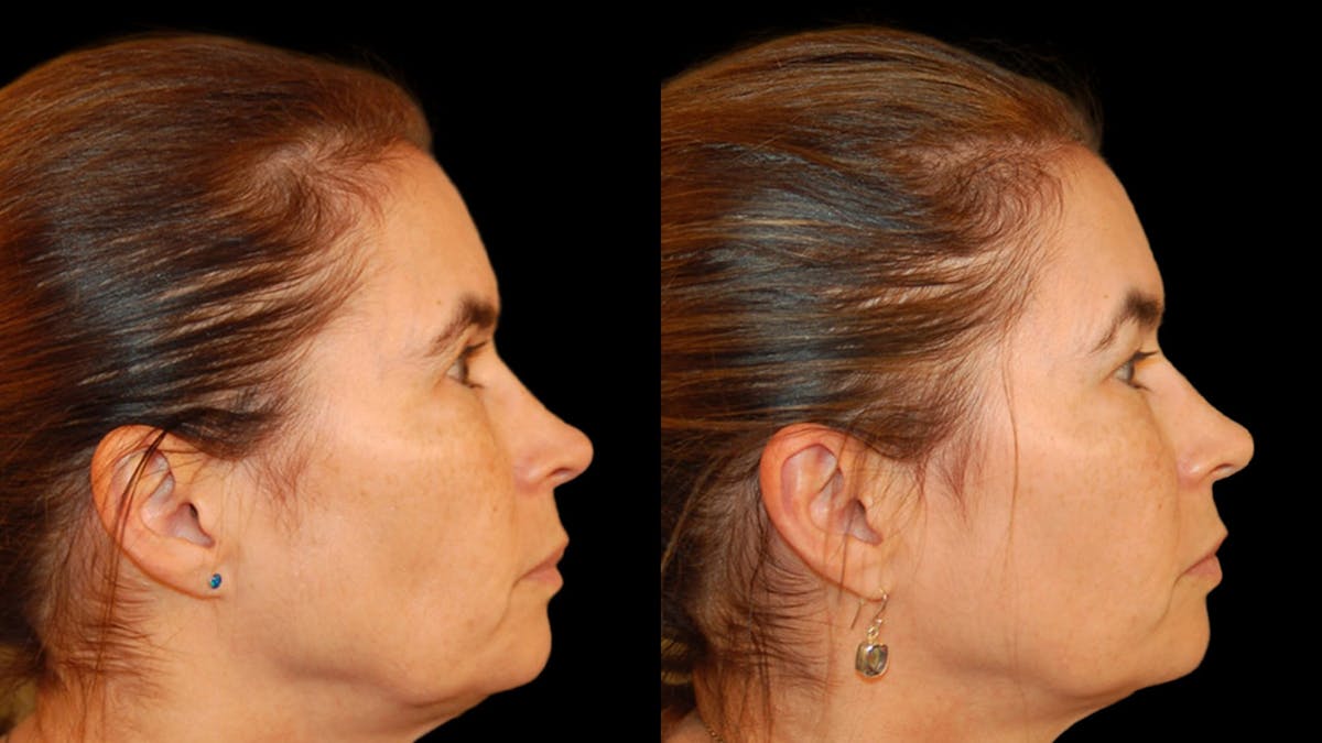 Upper Eyelid Surgery Before & After Gallery - Patient 304034 - Image 4
