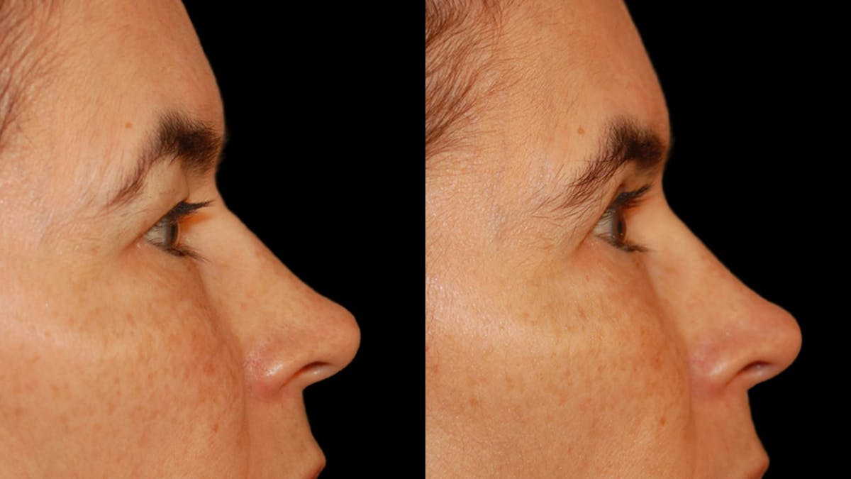 Upper Eyelid Surgery Before & After Gallery - Patient 304034 - Image 8