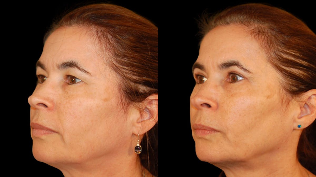 Upper Eyelid Surgery Before & After Gallery - Patient 304034 - Image 1