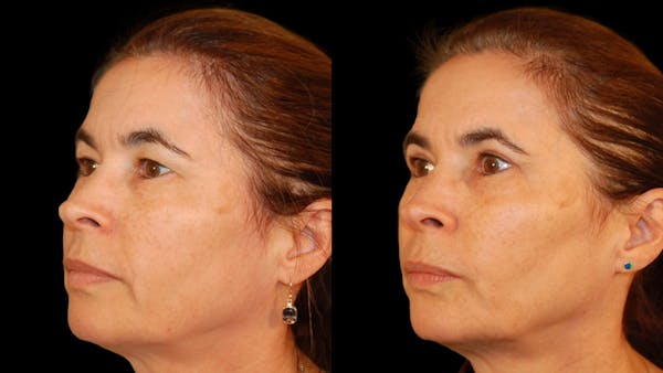 Upper Eyelid Surgery Before & After Gallery - Patient 304034 - Image 1