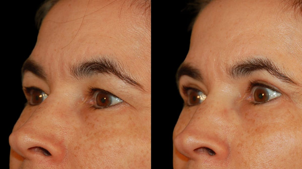 Upper Eyelid Surgery Before & After Gallery - Patient 304034 - Image 7