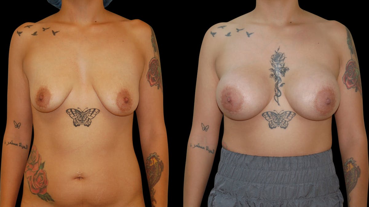 Breast Augmentation Before & After Gallery - Patient 376708 - Image 1