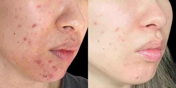 Aviclear Before & After Gallery - Patient 341560 - Image 1