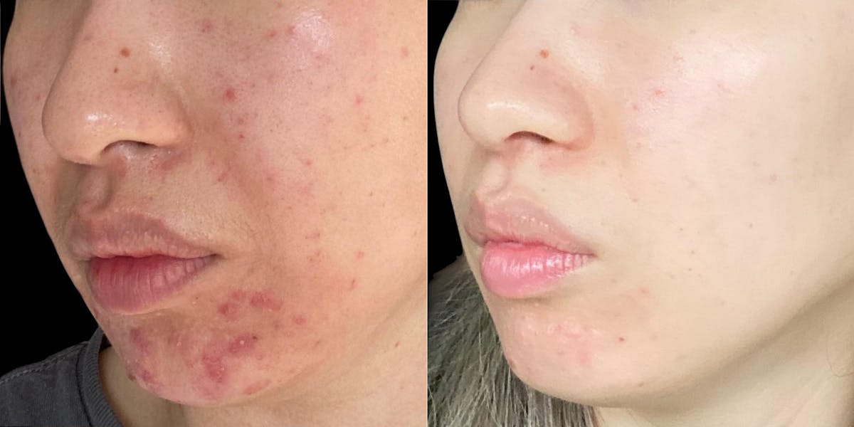 Aviclear Before & After Gallery - Patient 341560 - Image 2
