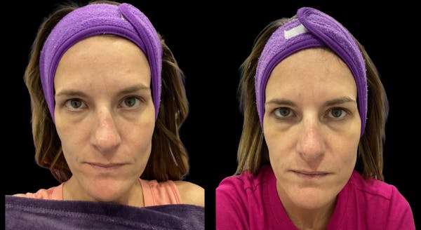 IPL Before & After Gallery - Patient 114369 - Image 1