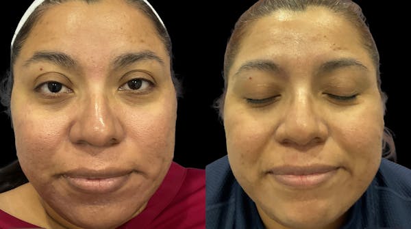 IPL Before & After Gallery - Patient 427684 - Image 1