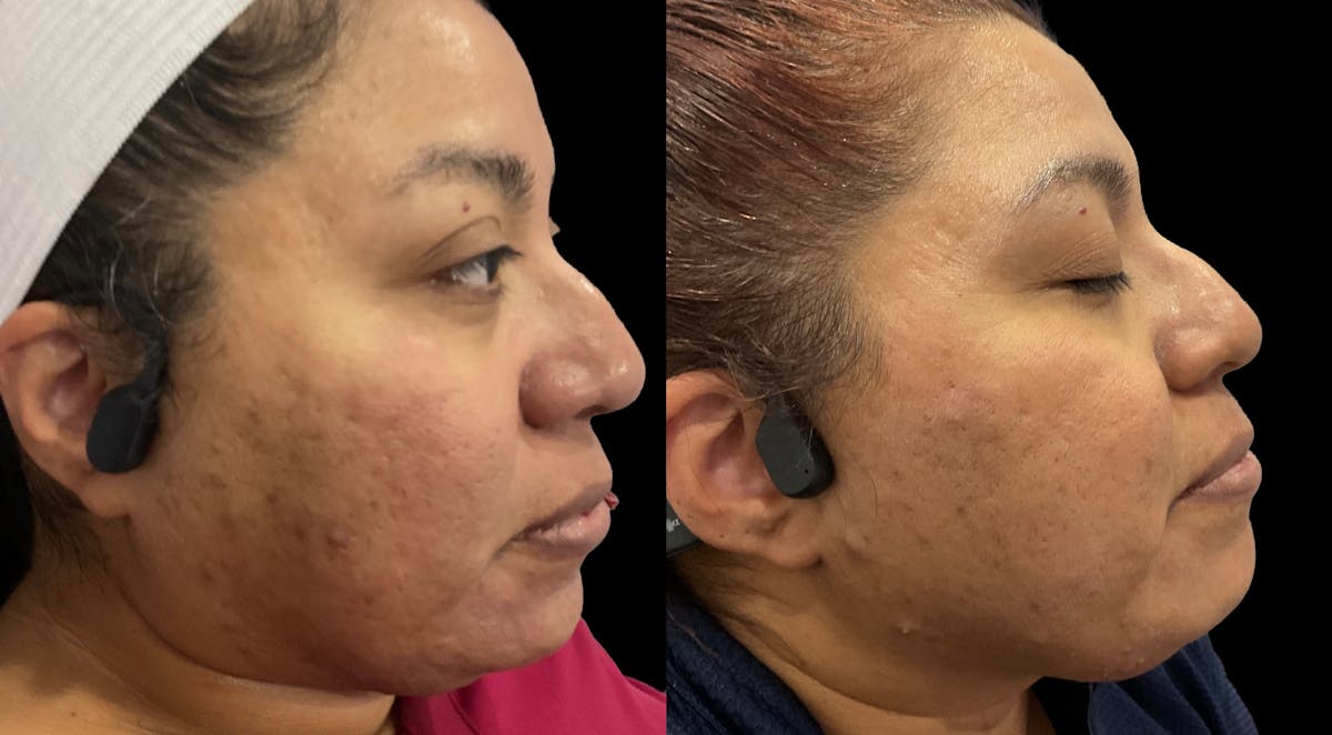 IPL Before & After Gallery - Patient 427684 - Image 2
