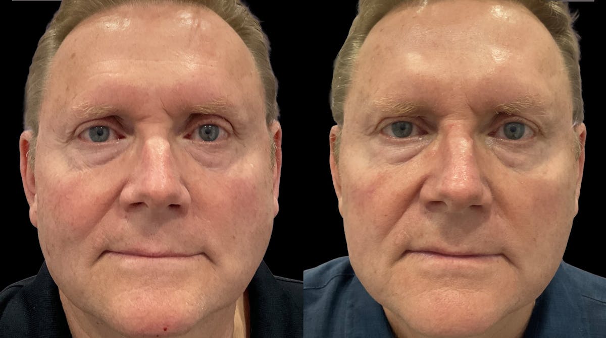 IPL Before & After Gallery - Patient 324326 - Image 1