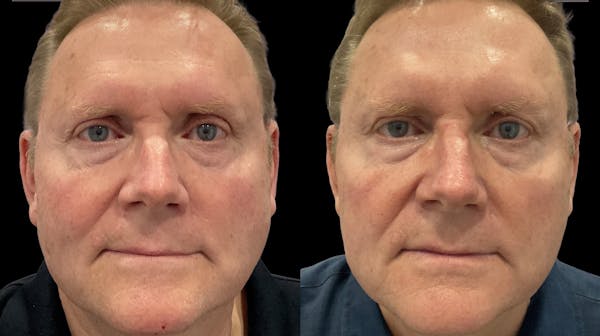 IPL Before & After Gallery - Patient 324326 - Image 1