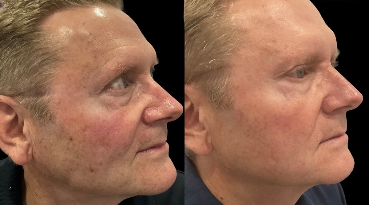 IPL Before & After Gallery - Patient 324326 - Image 2