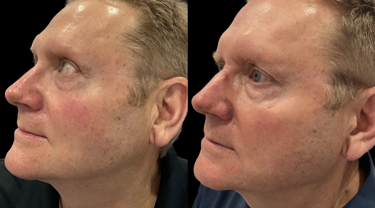 IPL Before & After Gallery - Patient 324326 - Image 3