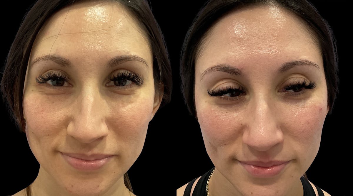 IPL Before & After Gallery - Patient 252002 - Image 1