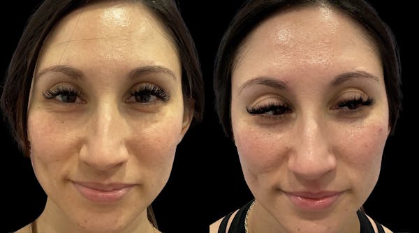 IPL Before & After Gallery - Patient 252002 - Image 1