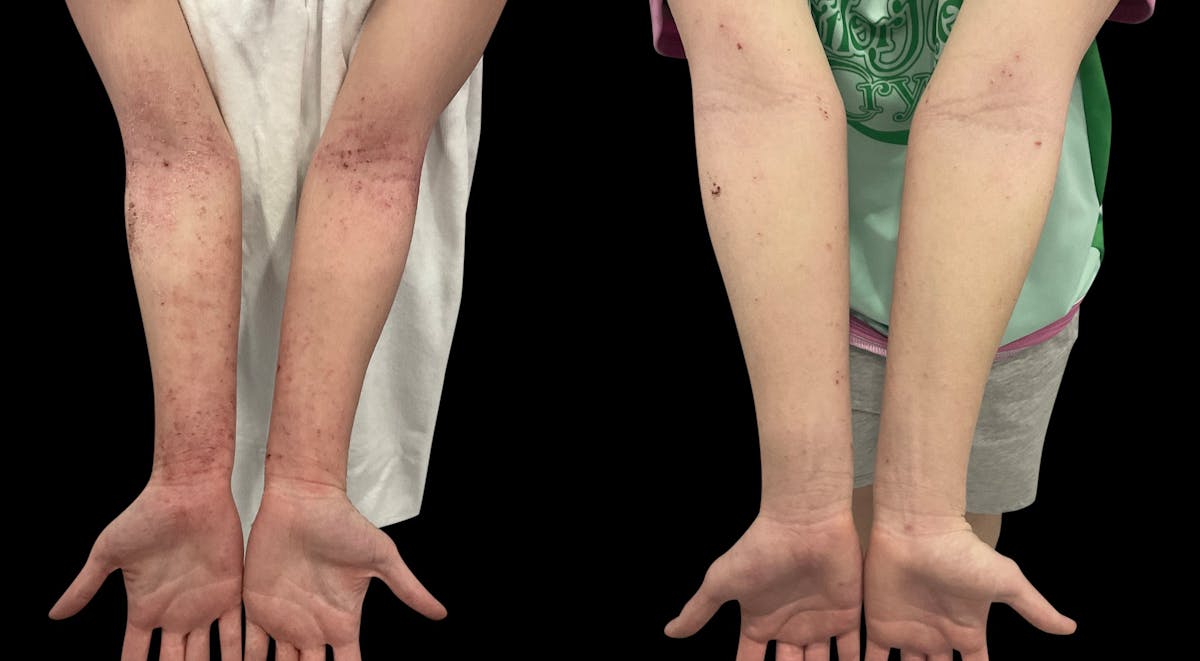 LightStim®  Before & After Gallery - Patient 140684 - Image 5