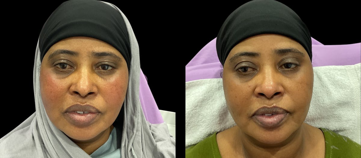 IPL Before & After Gallery - Patient 340484 - Image 1