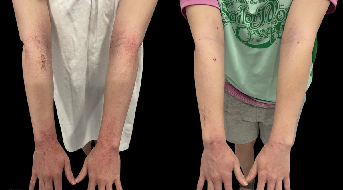 LightStim®  Before & After Gallery - Patient 140684 - Image 6