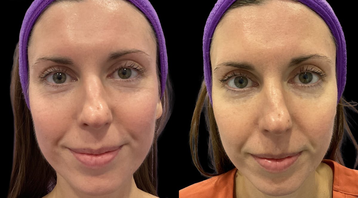 IPL Before & After Gallery - Patient 301660 - Image 1
