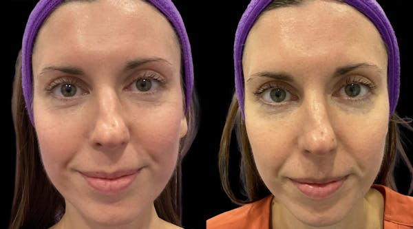 IPL Before & After Gallery - Patient 301660 - Image 1
