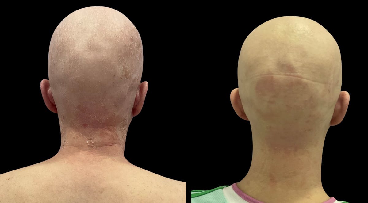 LightStim®  Before & After Gallery - Patient 140684 - Image 4