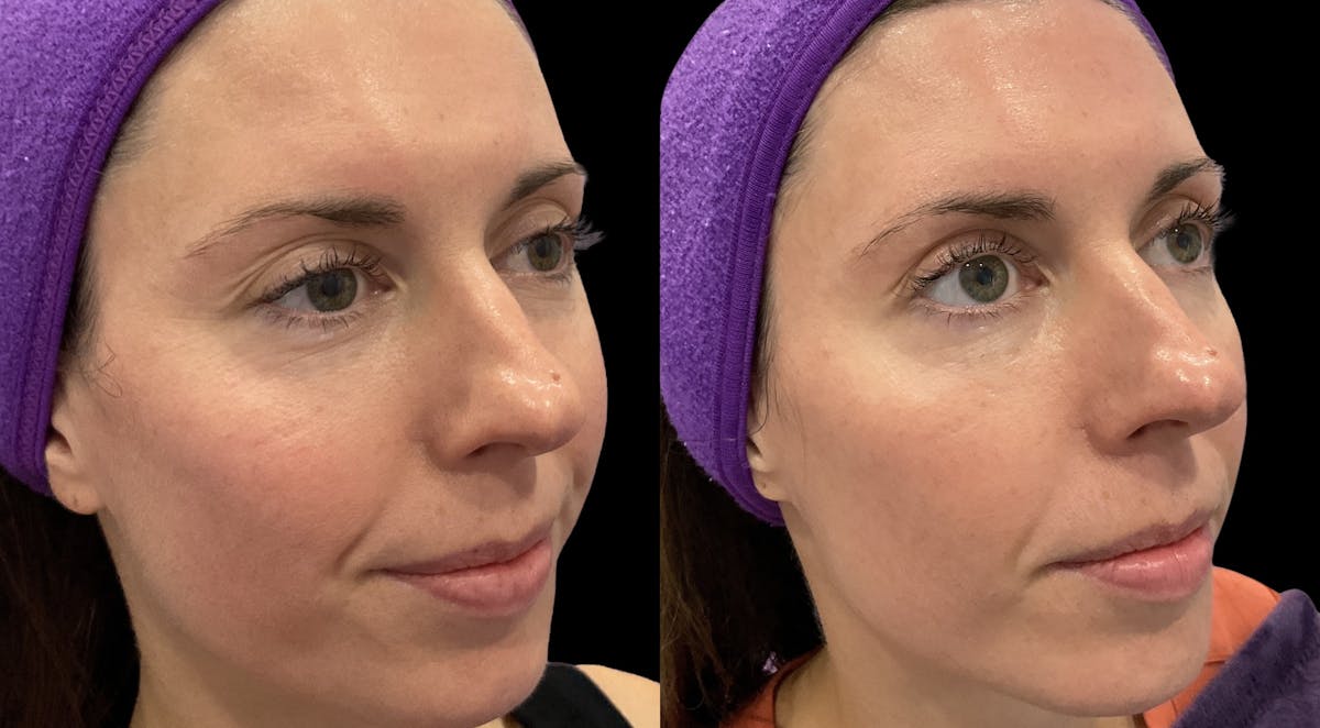IPL Before & After Gallery - Patient 301660 - Image 2