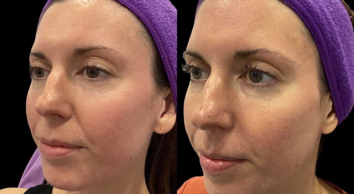 IPL Before & After Gallery - Patient 301660 - Image 3