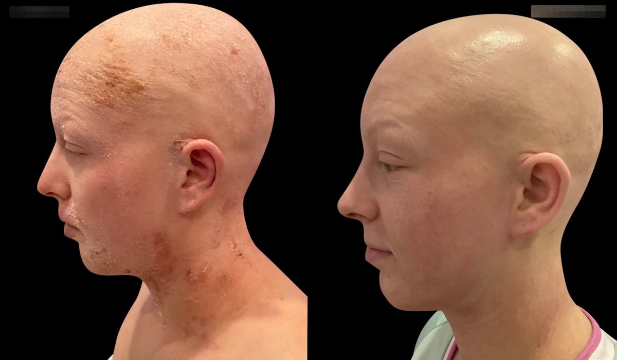 LightStim®  Before & After Gallery - Patient 140684 - Image 3