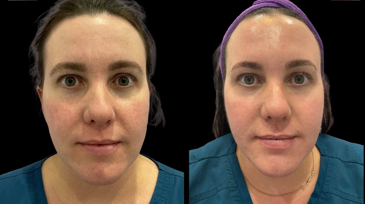 IPL Before & After Gallery - Patient 274443 - Image 1