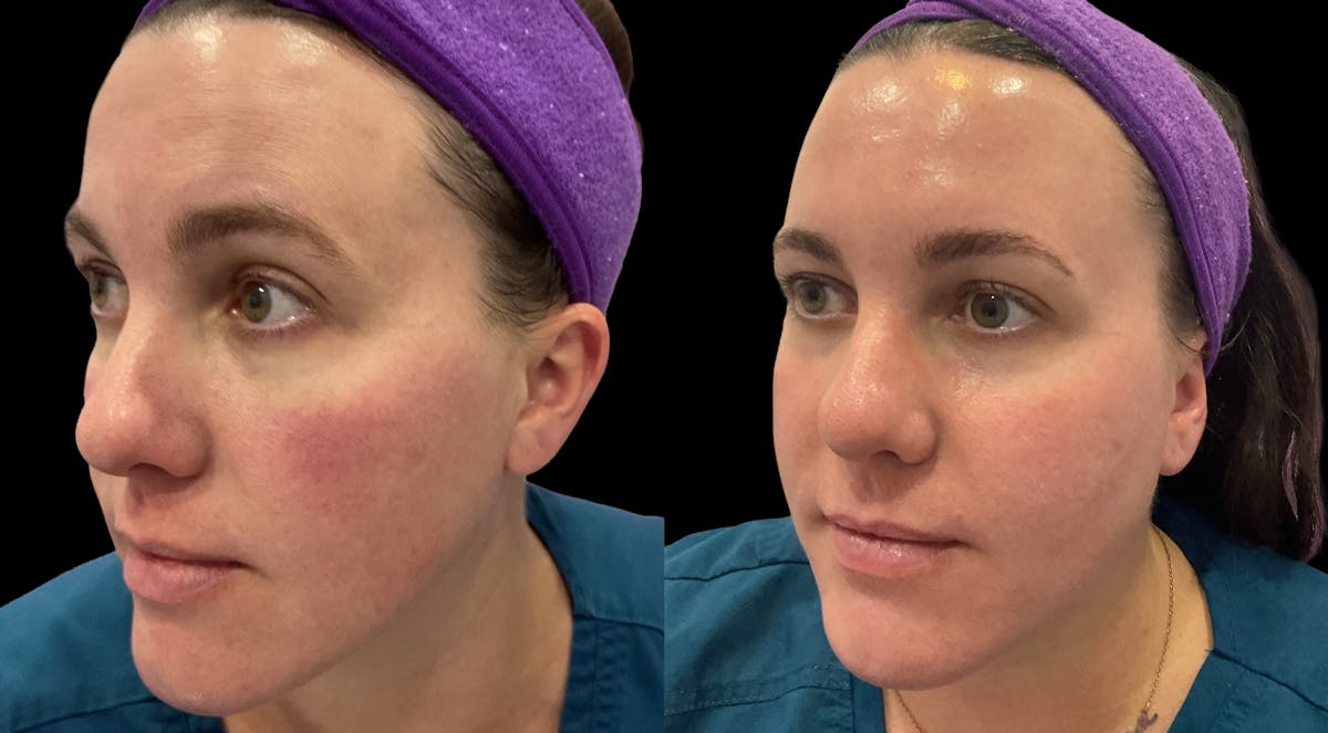 IPL Before & After Gallery - Patient 274443 - Image 2