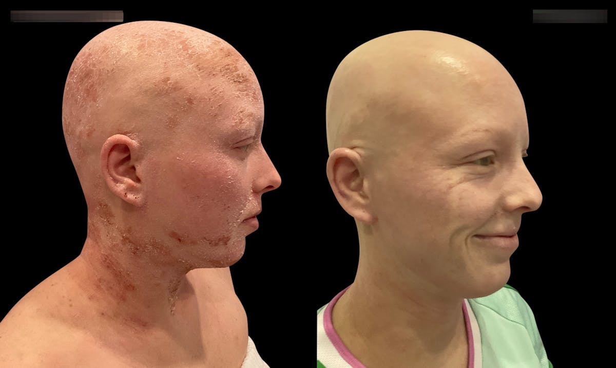 LightStim®  Before & After Gallery - Patient 140684 - Image 2