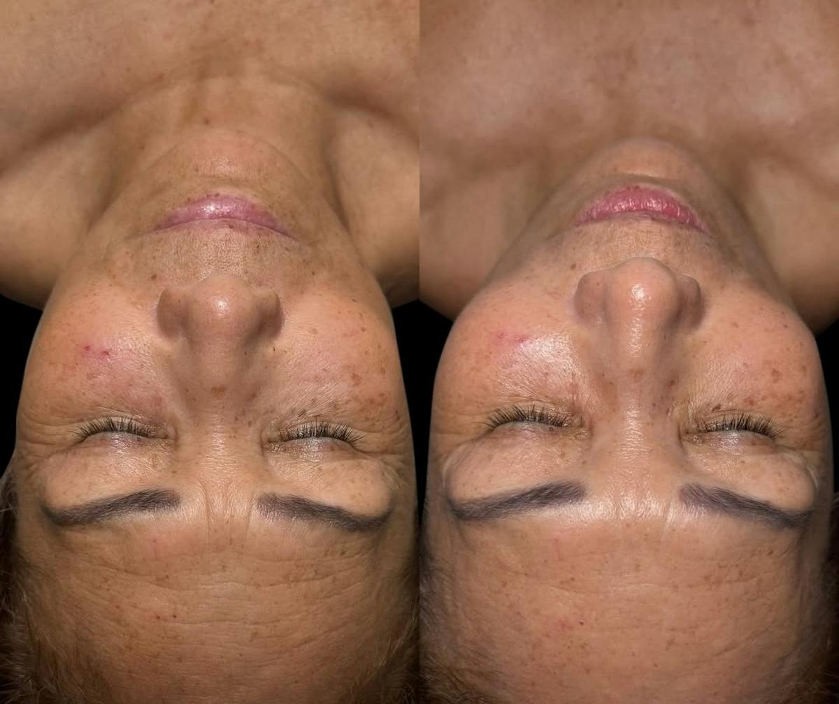 LightStim®  Before & After Gallery - Patient 407620 - Image 1