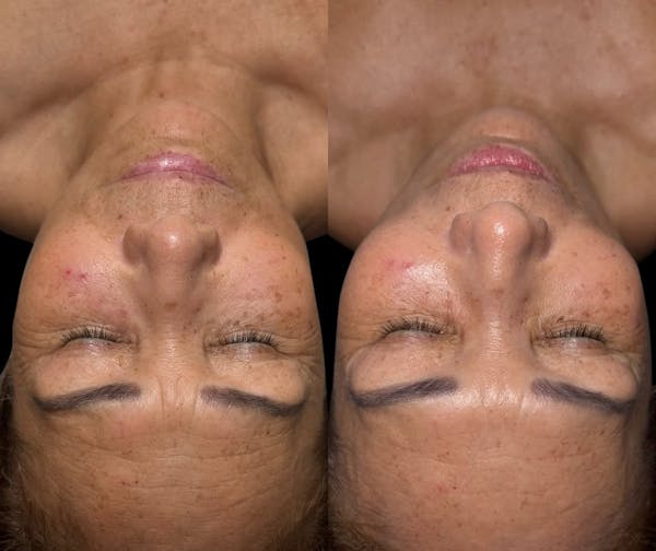 LightStim®  Before & After Gallery - Patient 407620 - Image 1