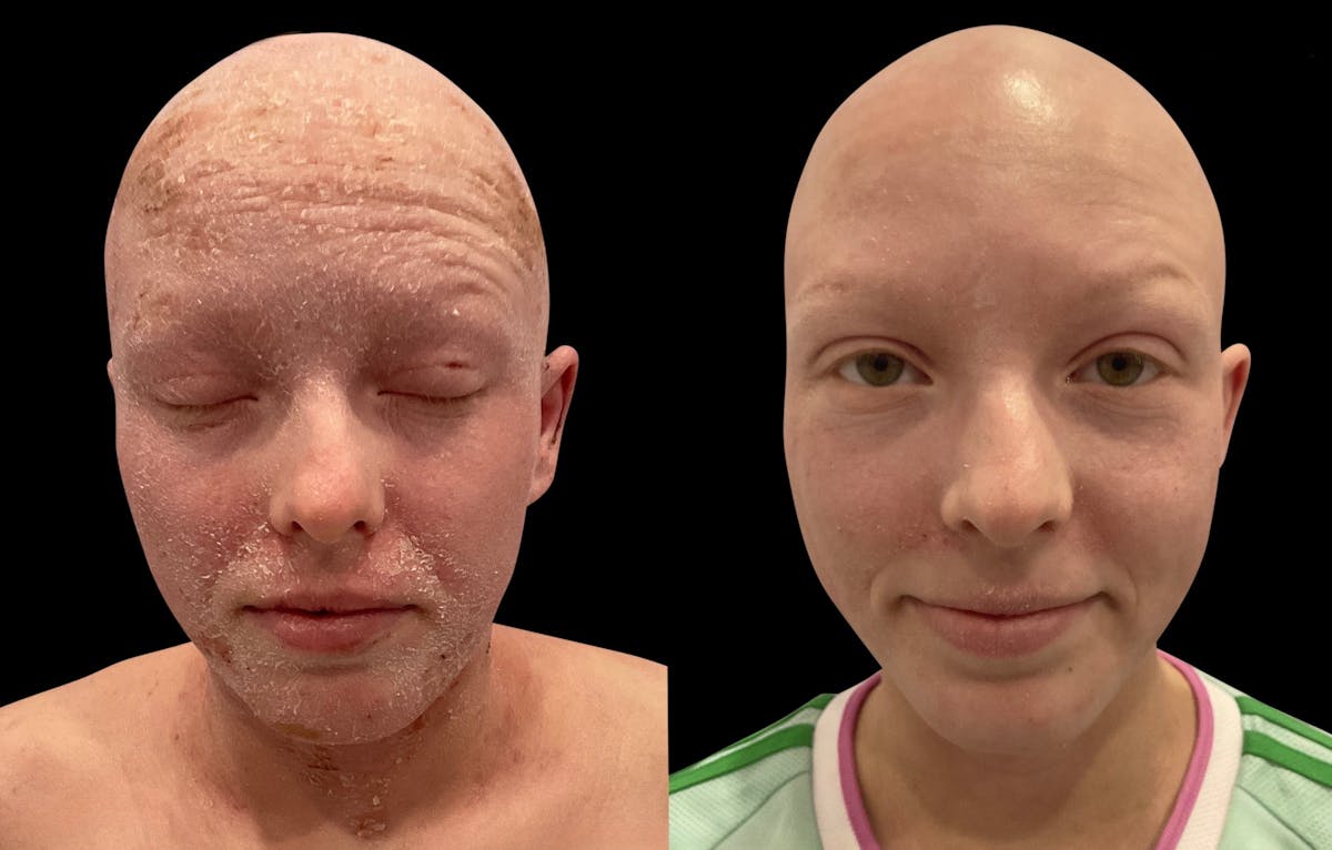 LightStim®  Before & After Gallery - Patient 140684 - Image 1