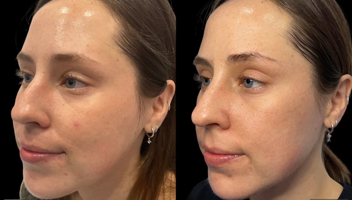 Microneedling Before & After Gallery - Patient 133365 - Image 1