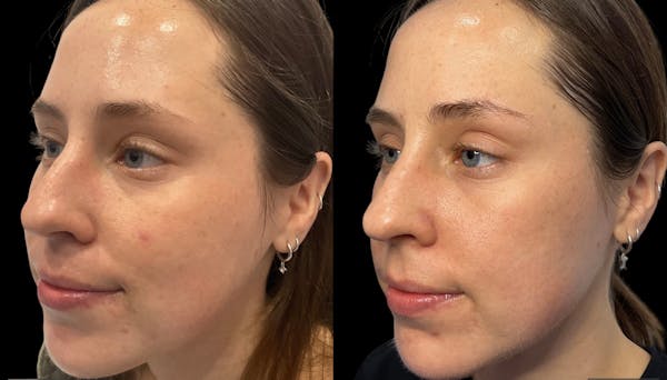 Microneedling Before & After Gallery - Patient 133365 - Image 1