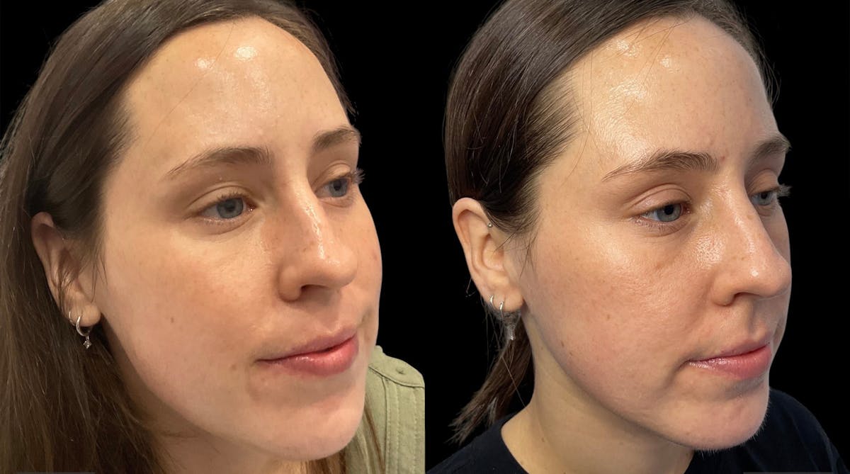 Microneedling Before & After Gallery - Patient 133365 - Image 2