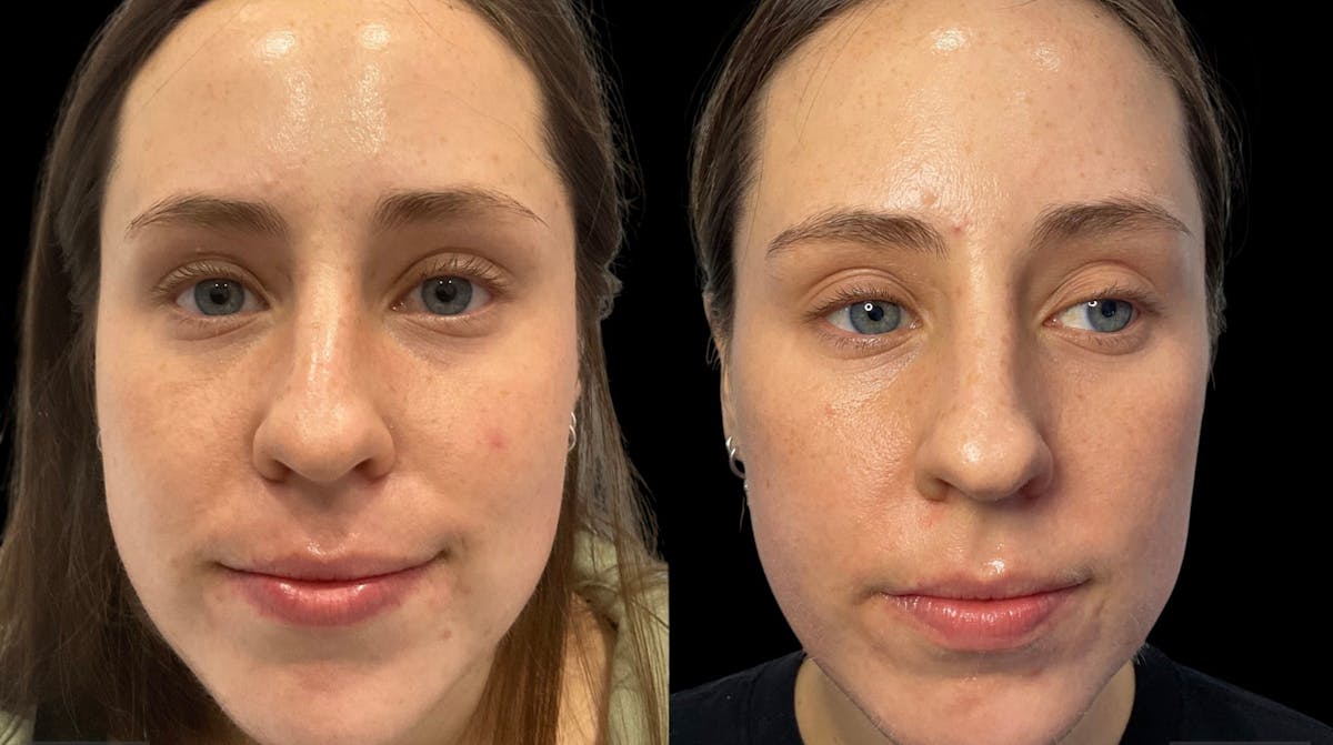 Microneedling Before & After Gallery - Patient 133365 - Image 3