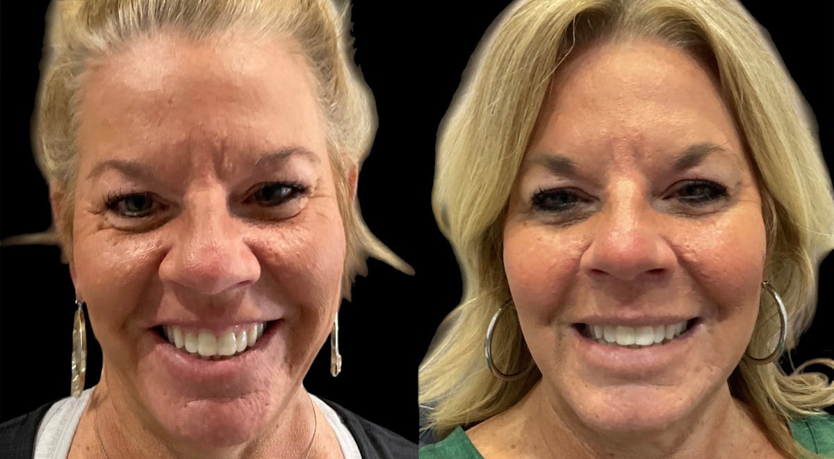 Microneedling Before & After Gallery - Patient 349517 - Image 1