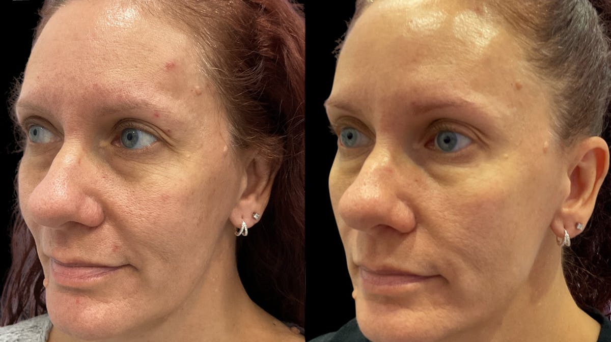 Microneedling Before & After Gallery - Patient 225875 - Image 1