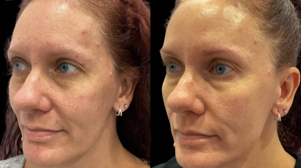 Microneedling Before & After Gallery - Patient 225875 - Image 1