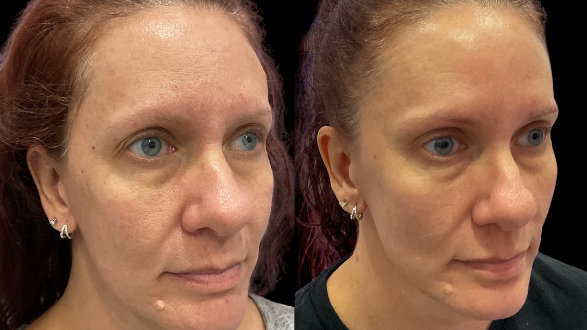 Microneedling Before & After Gallery - Patient 225875 - Image 2