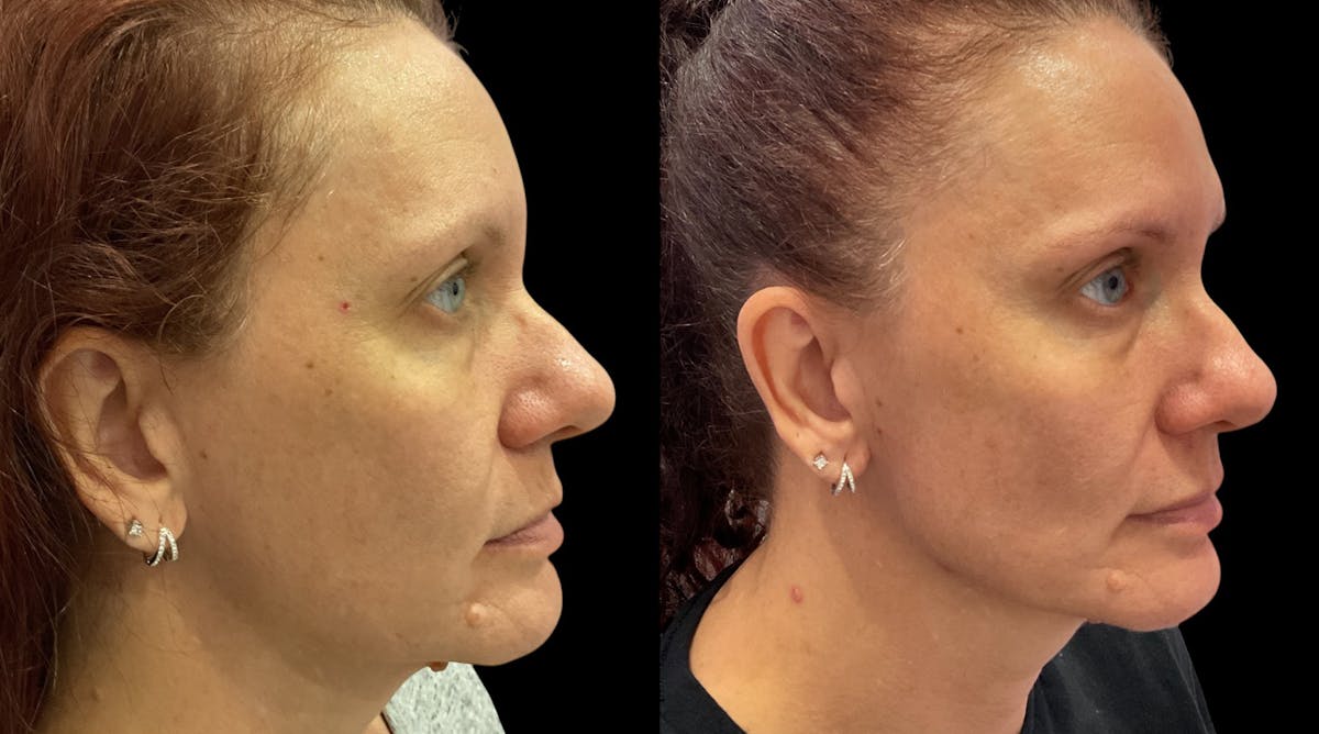Microneedling Before & After Gallery - Patient 225875 - Image 3