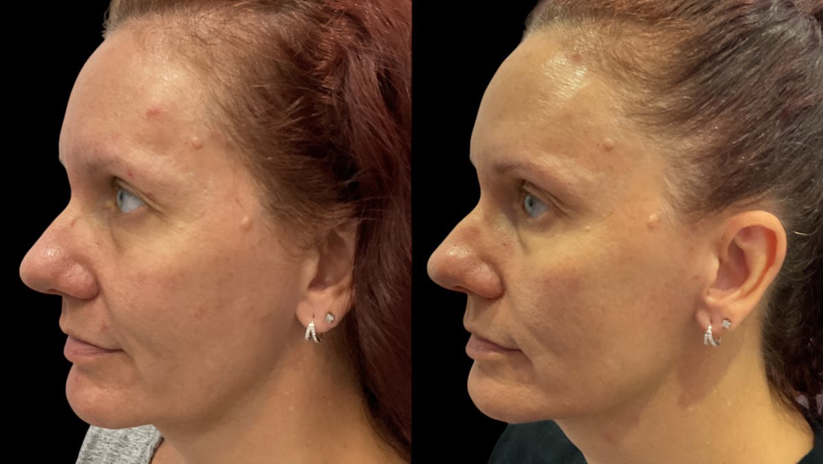 Microneedling Before & After Gallery - Patient 225875 - Image 4
